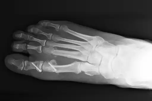 Interruption de 6 semaines - Pied Pascal Pied Pascal